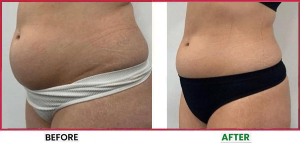 Body Sculpting Before & After 7