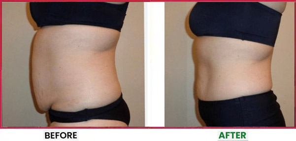 Body Sculpting Before & After 8