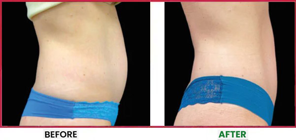 Body Sculpting Before & After 9