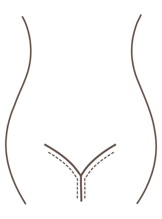 Vulvar Augmentation