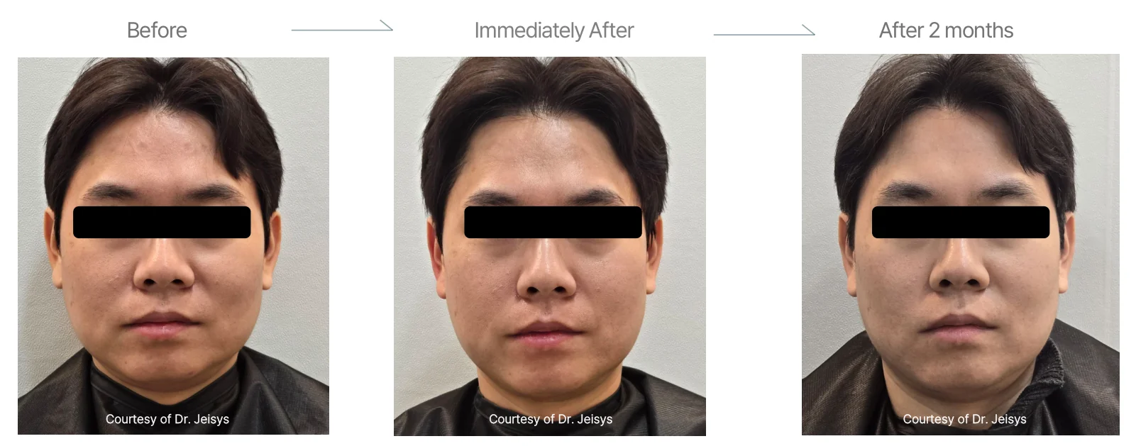 Density RF before and after: male, early 40s, cheeks, double chin and forehead, before to 2 months
