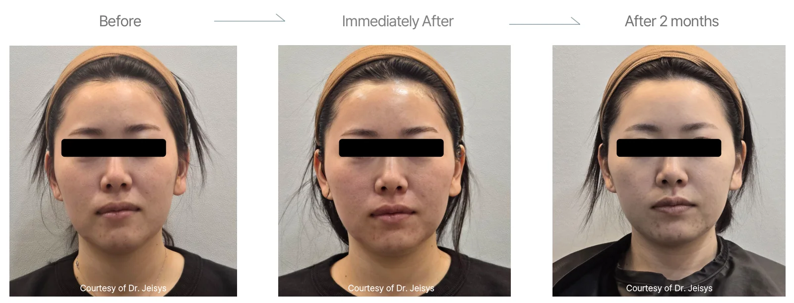 Density RF before and after: female, late 20s, cheeks, double chin and forehead, before to 2 months