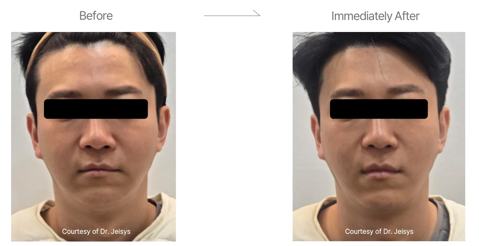 Density RF before and after: male, early 40s, cheeks, double chin and forehead, before to immediately after