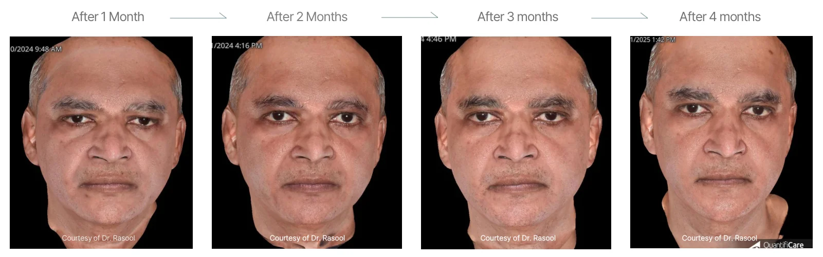 Density RF results: male, 56, cheeks, forehead and lower chin, 1 month to 4 months