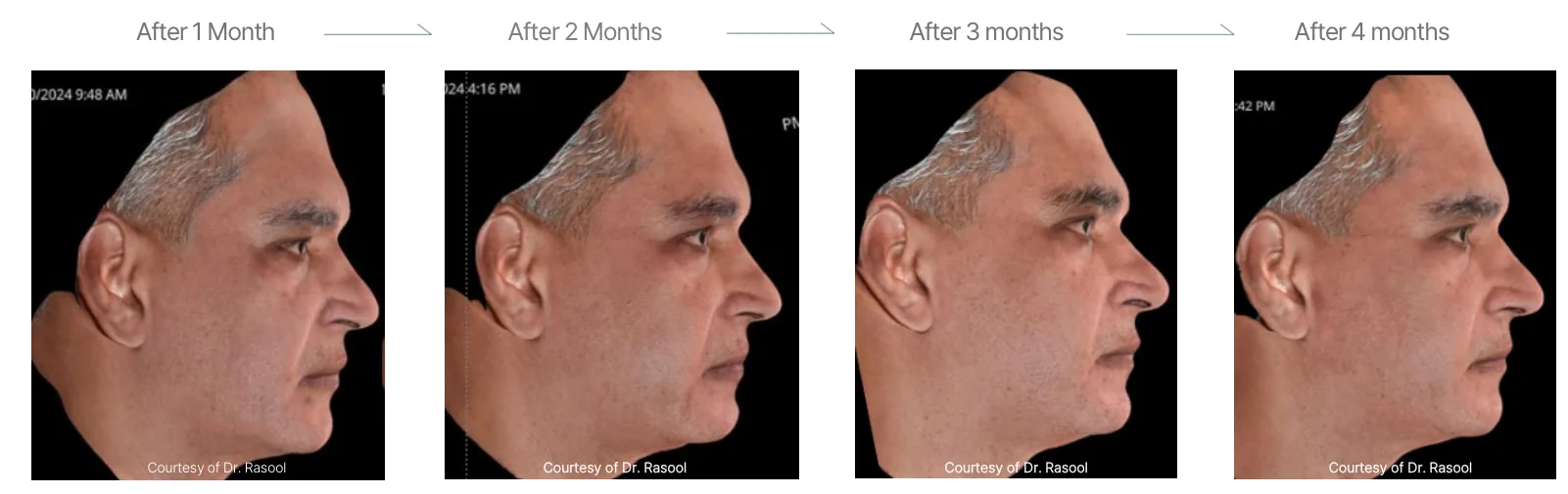 Density RF results, profile view: male, 56, cheeks, forehead and lower chin, 1 month to 4 months