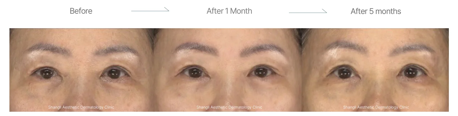 Density RF before and after: female, 65, upper and lower eyelids and crow's feet, before to 5 months