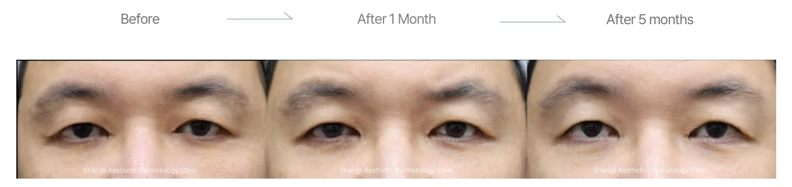 Density RF before and after: male, 48, upper and lower eyelids and crow's feet, before to 5 months