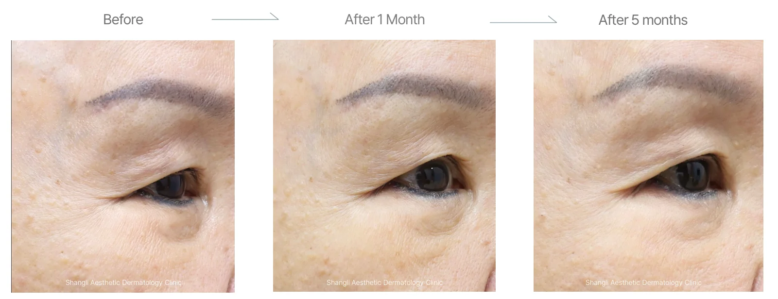 Density RF before and after: female, 77, upper and lower eyelids and crow's feet, before to 5 months
