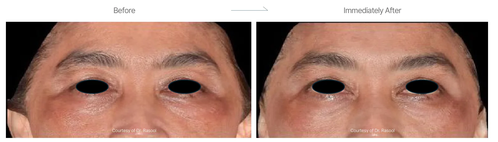 Density RF before and after: male, 61, eye area, before to immediately after