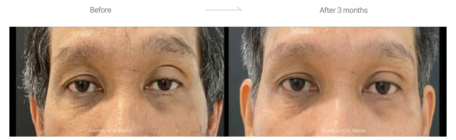 Density RF before and after: male, eye area, before to 3 months