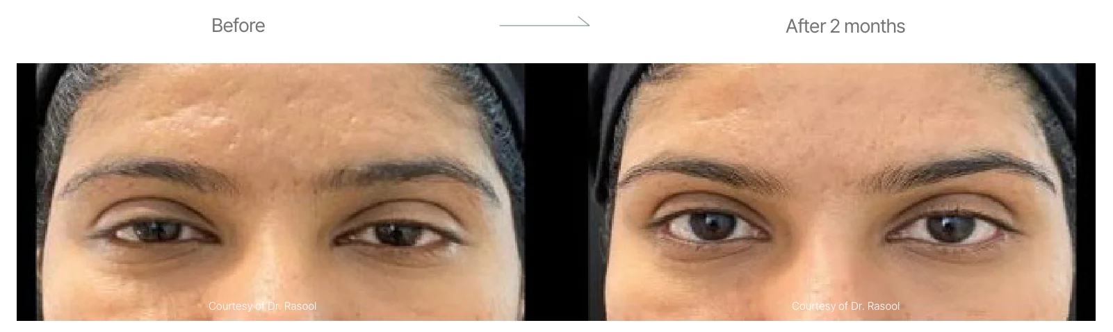 Density RF before and after: female, eye area, before to 2 months