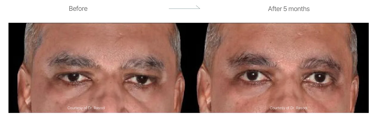 Density RF before and after: male, 56, forehead, before to 5 months