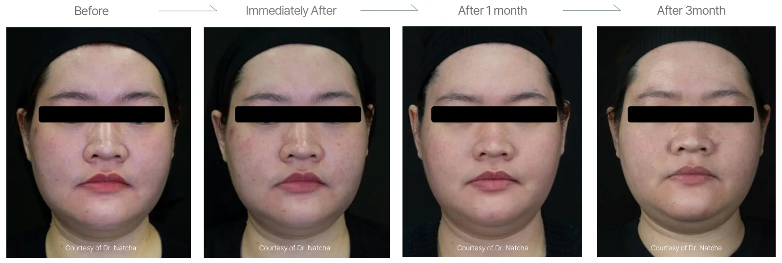 Density RF before and after: female, 28, cheeks and double chin, before to 3 months