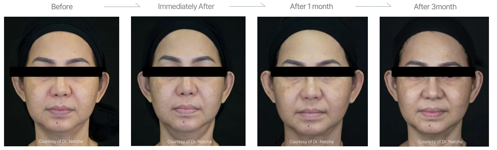 Density RF before and after: female, 58, cheeks, double chin and forehead, before to 3 months
