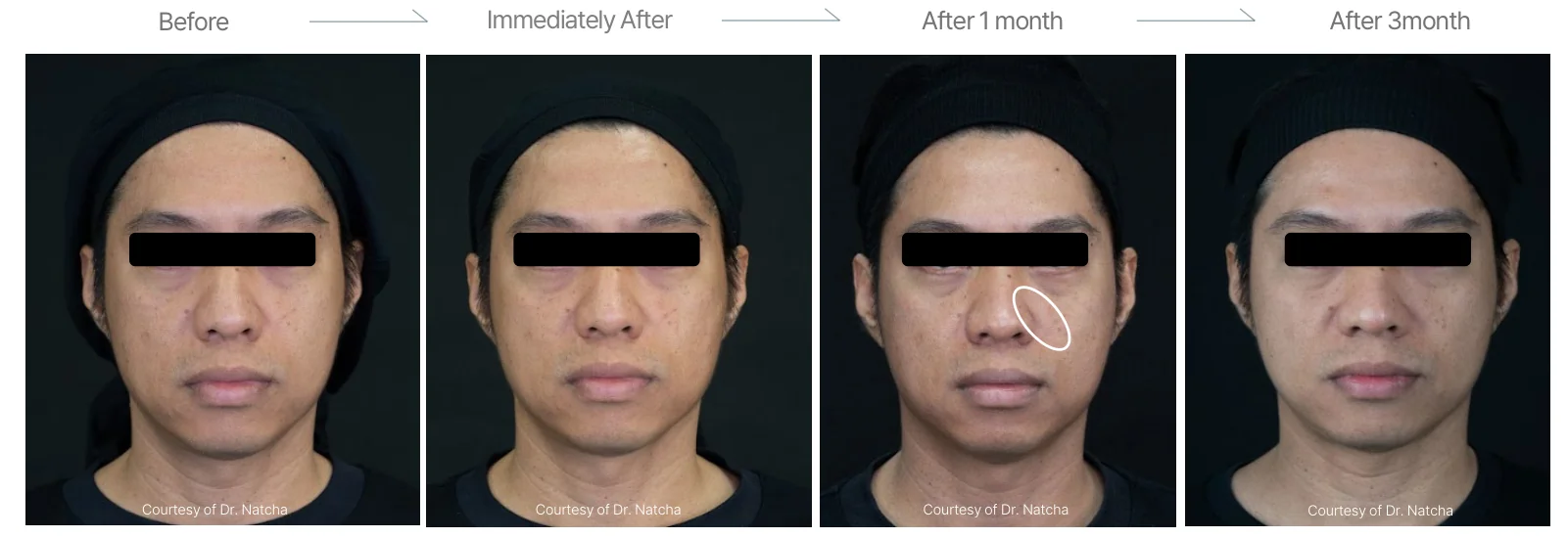 Density RF before and after: male, 44, cheeks and double chin, before to 3 months