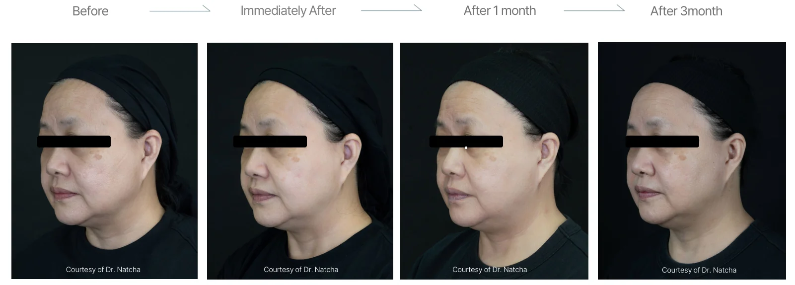 Density RF before and after: female, 56, cheeks, double chin and forehead, before to 3 months