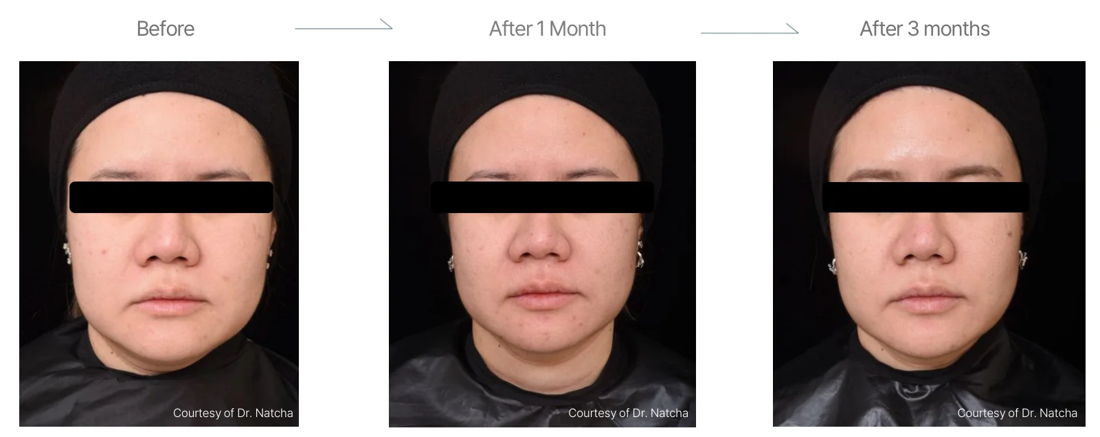 Density RF before and after: female, cheeks, jawline and periorbital region, before to 3 months