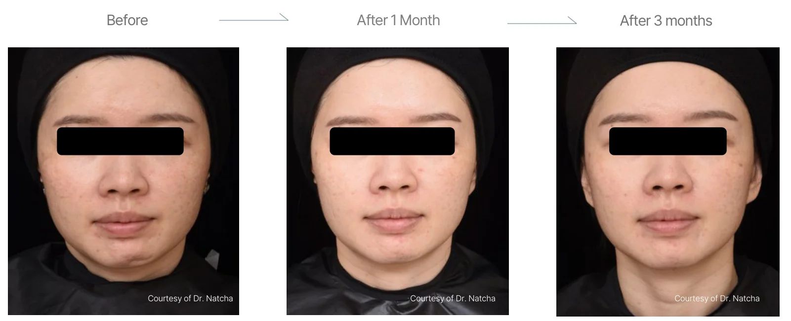 Density RF before and after: female, cheeks, jawline and periorbital region, before to 3 months