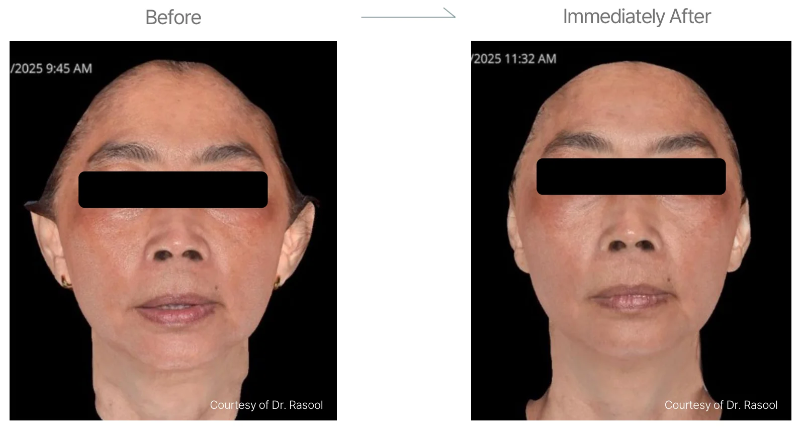 Density RF before and after: female, 61, cheeks, double chin and forehead, before to immediately after