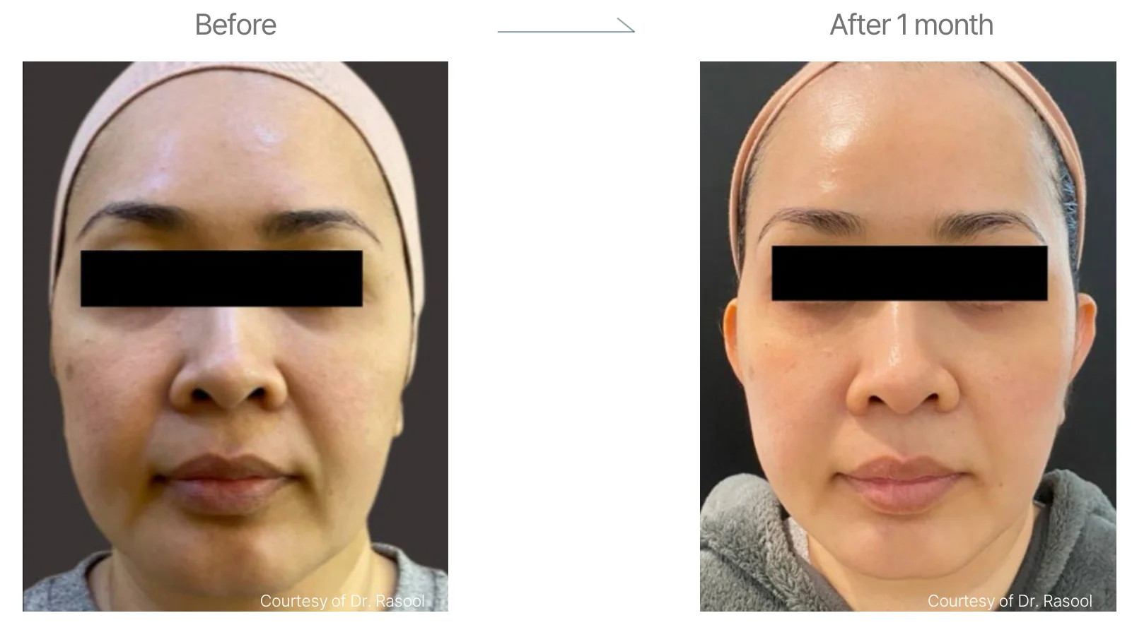 Density RF before and after: female, cheeks, double chin and forehead, before to 1 month