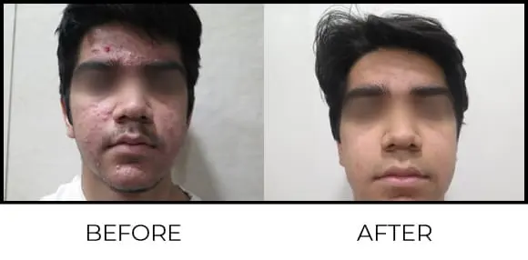 BioRePeel Before & After 10