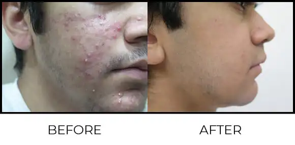 BioRePeel Before & After 11