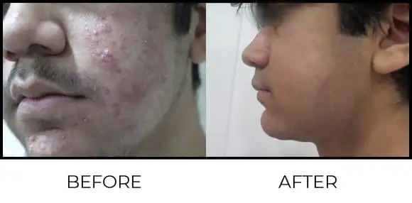 BioRePeel Before & After 12