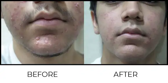 BioRePeel Before & After 13