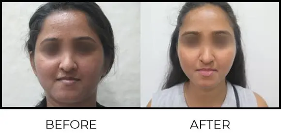 BioRePeel Before & After 6