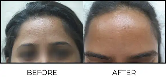 BioRePeel Before & After 7