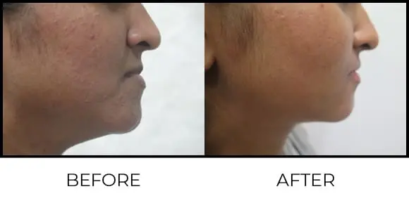 BioRePeel Before & After 9