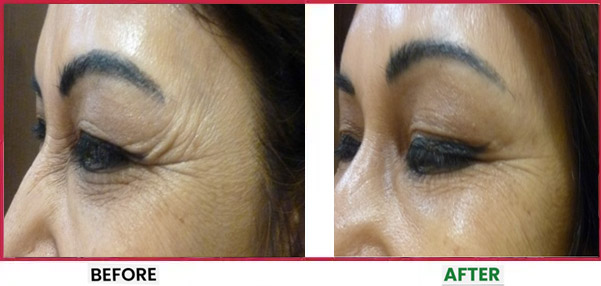 Botox Treatment in Mumbai Before & After 3