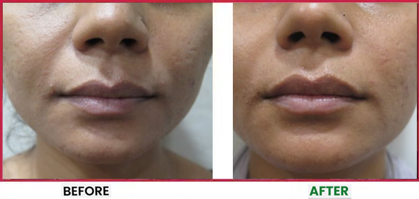 Botox Treatment in Mumbai Before & After 4