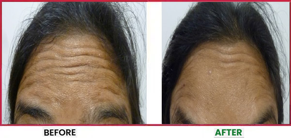 Botox Treatment in Mumbai Before & After 5