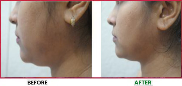Chemical Peel Before & After 1