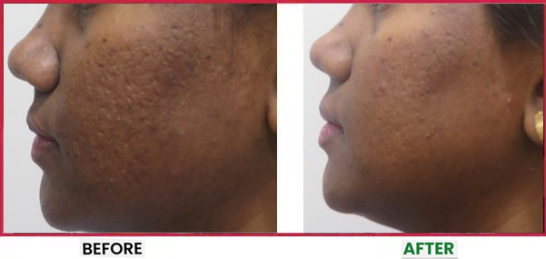 Chemical Peel Before & After 2