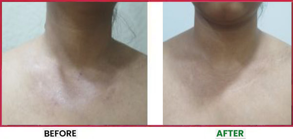 Chemical Peel Before & After 3