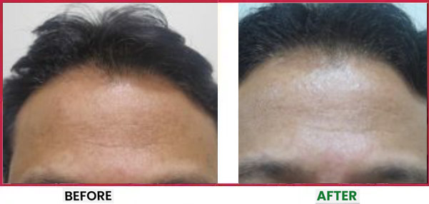 Chemical Peel Before & After 4