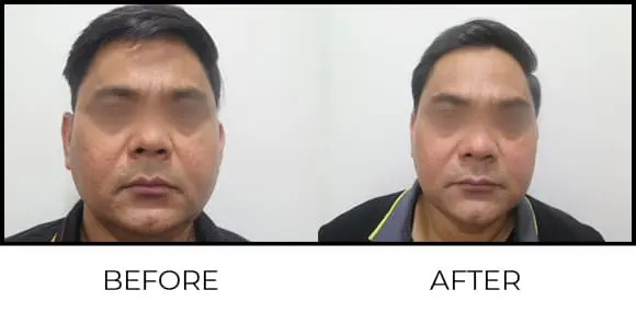 Derma Pen Before & After 1