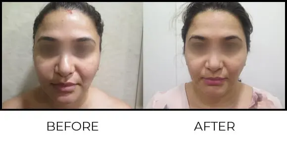 Derma Pen Before & After 2