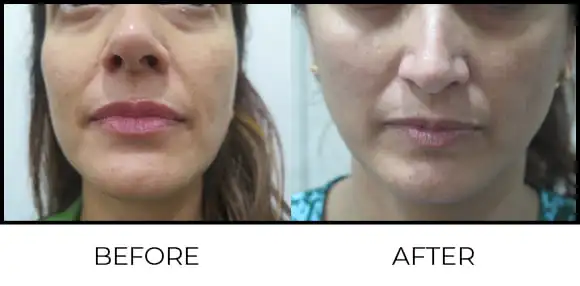 Derma Pen Before & After 3