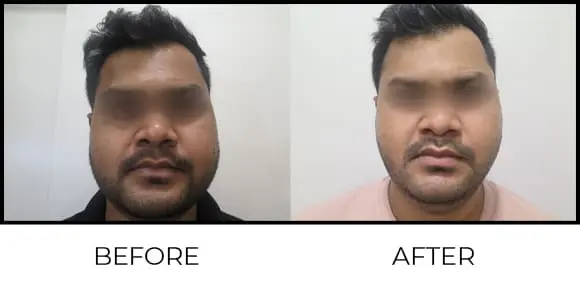 Derma Pen Before & After 4