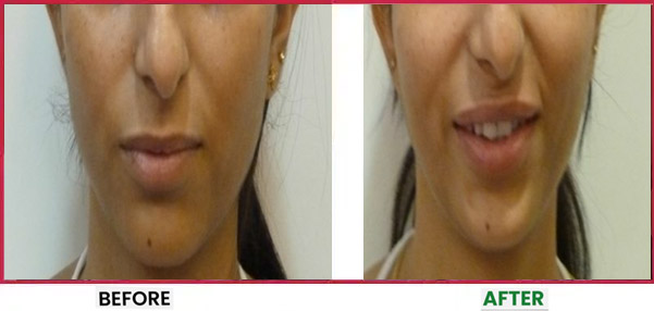 Dermal Fillers Treatment in Mumbai Before & After 2