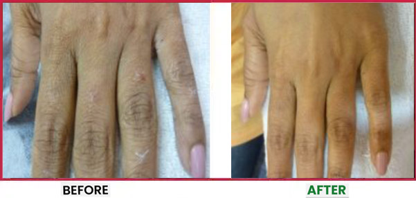 Dermal Fillers Treatment in Mumbai Before & After 3