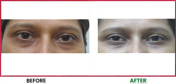 Dermal Fillers Treatment in Mumbai Before & After 4