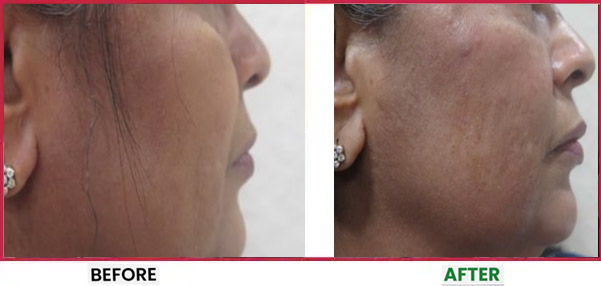 Dermal Fillers Treatment in Mumbai Before & After 5