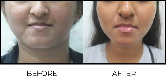 Dermamelan Peel Before & After 2