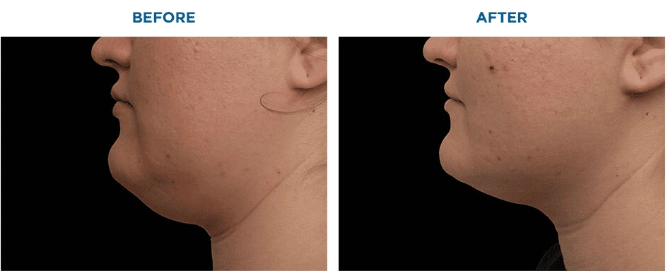 Submentum Before After 1