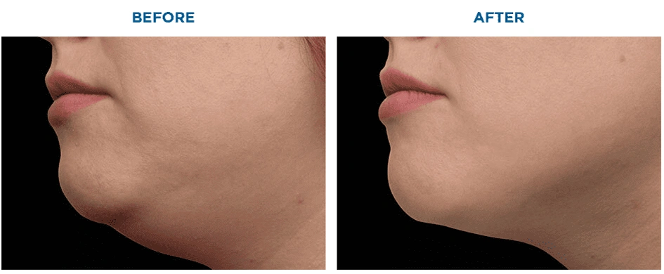 Submentum Before After 2
