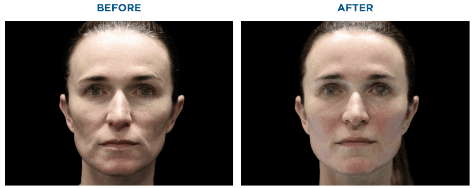 Submentum Before After 1